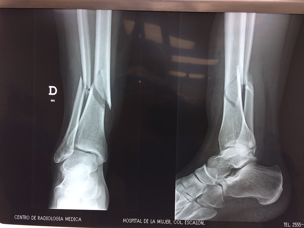 Cirugias De Perone Y Tibia